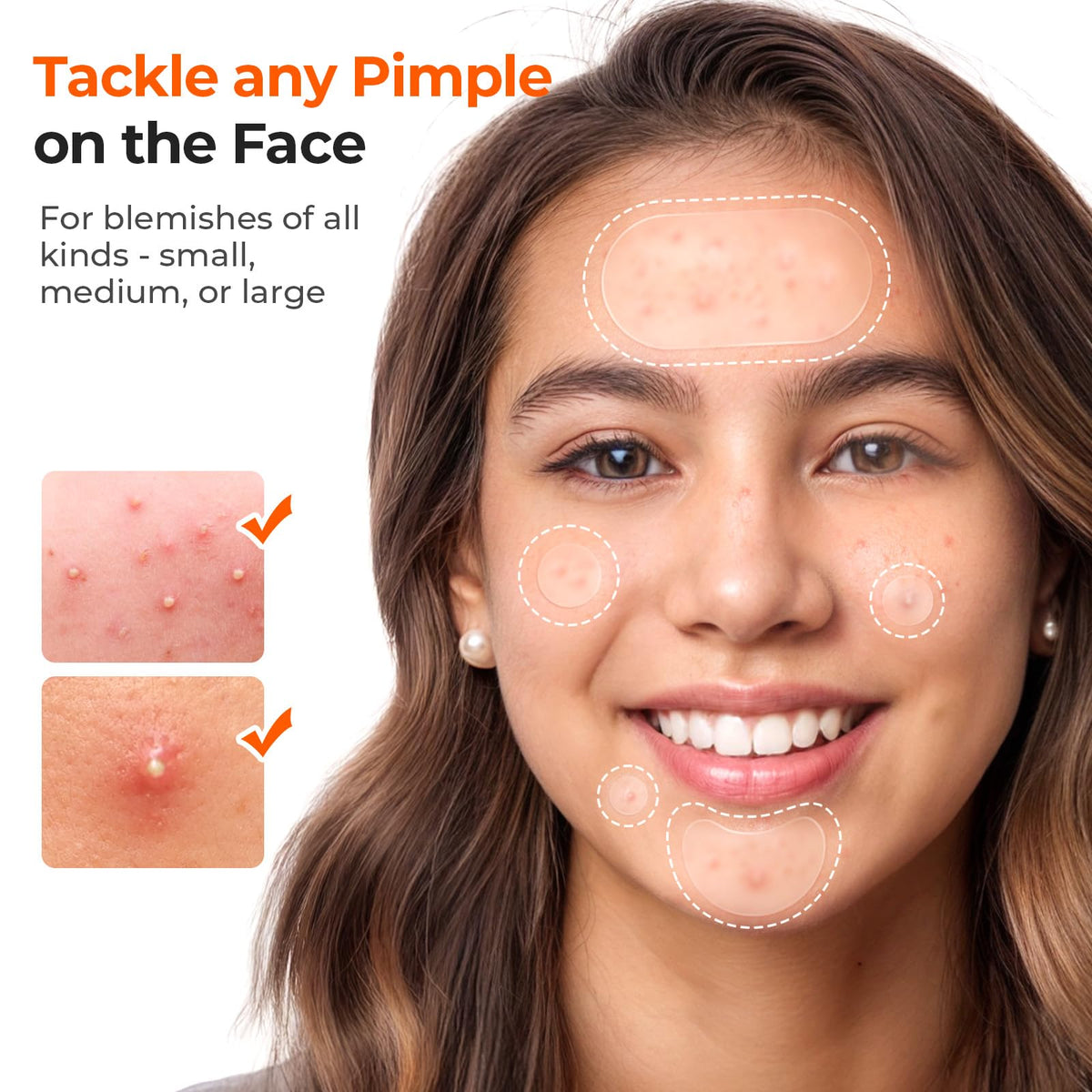 TKTK Large Hydrocolloid Pimple Patches for Acne Breakouts, 4 Big Sizes