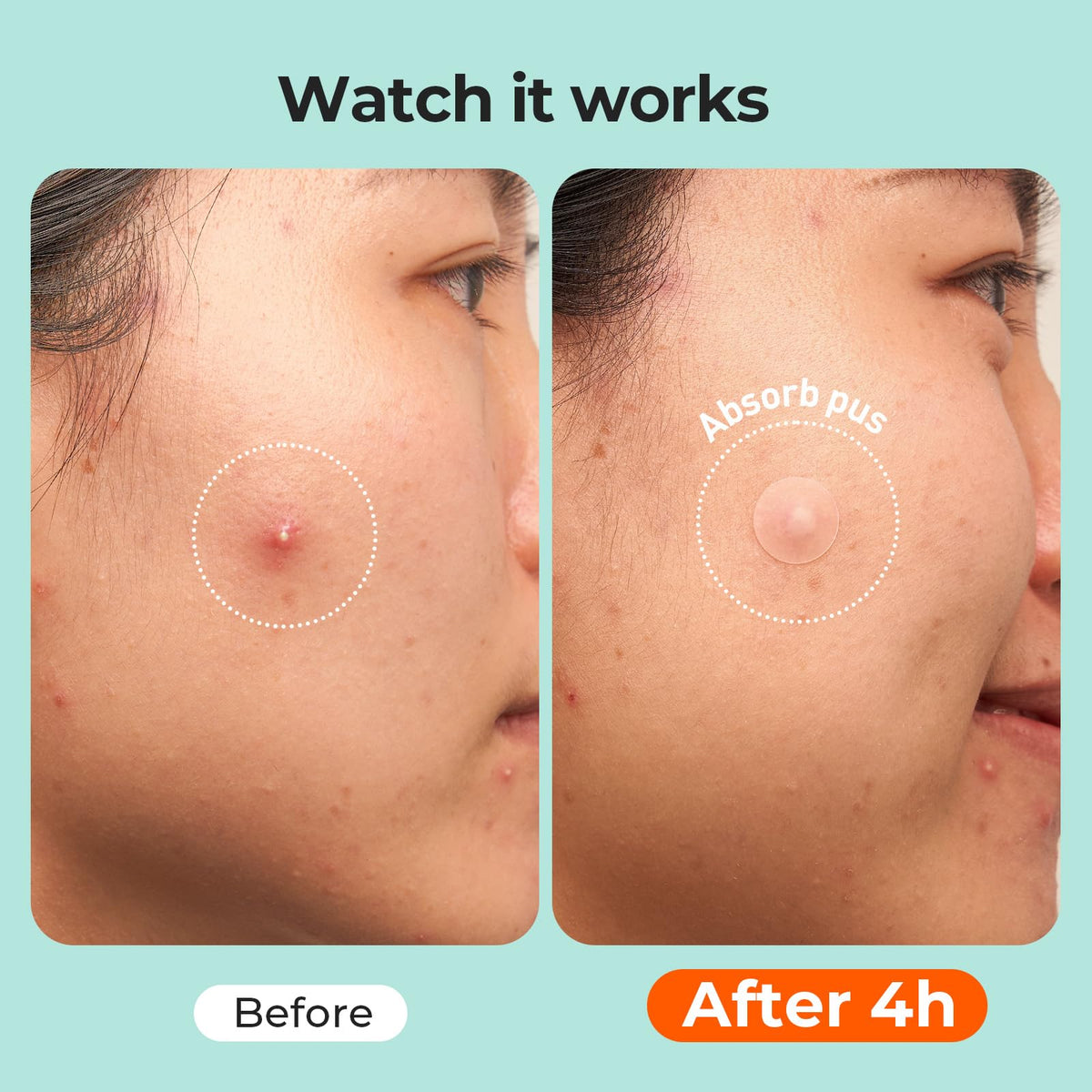 TKTK Large Hydrocolloid Pimple Patches for Acne Breakouts, 4 Big Sizes