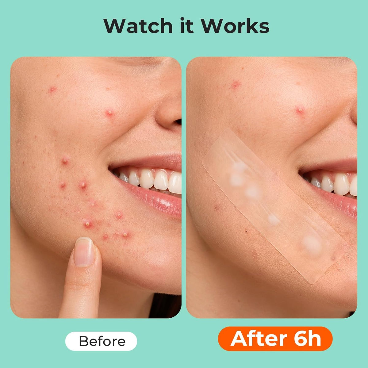 TKTK Large Hydrocolloid Pimple Patches for Acne Breakouts, 4 Big Sizes