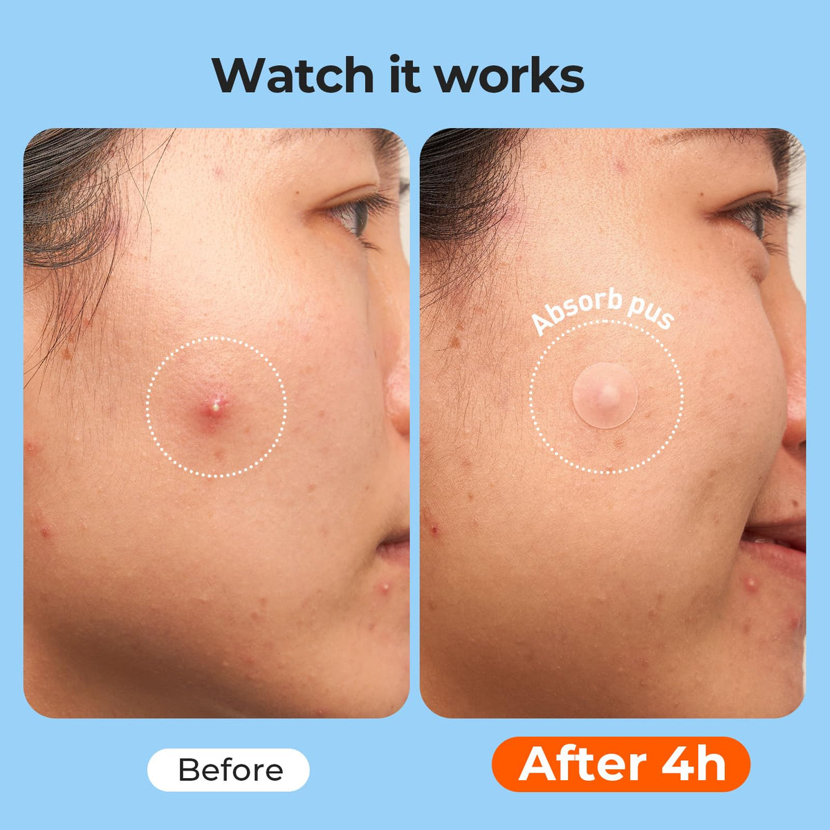 TKTK Large Hydrocolloid Pimple Patches for Acne Breakouts, 4 Big Sizes