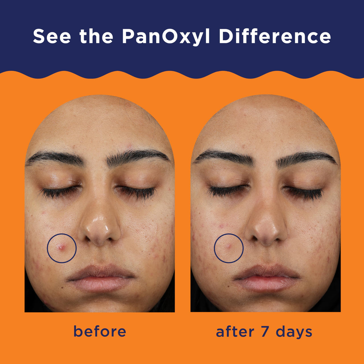 PanOxyl Acne Foaming Wash, 10% Benzoyl Peroxide, For Face & Body, 5.5 oz